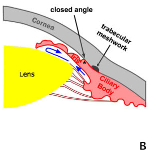 Pupillary Block. Angle Closure